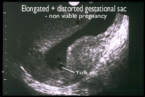 Irregular gestational sac at 7 weeks with heartbeat. Things To Know About Irregular gestational sac at 7 weeks with heartbeat. 
